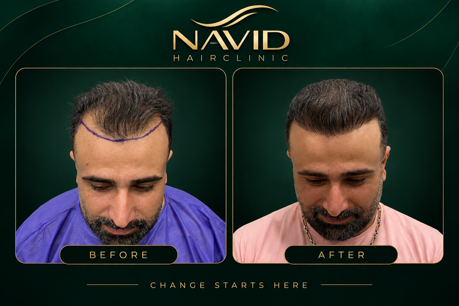 طراحی خط رویش